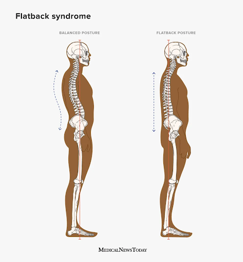 Flatback 